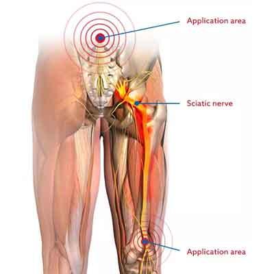 Image of body areas for Sciaticalm treatment points